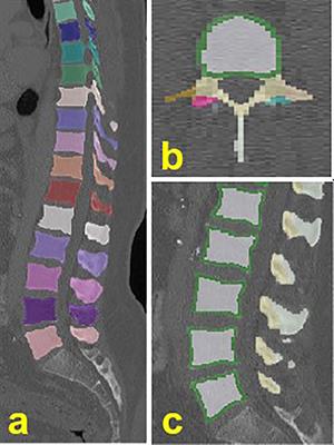 Gender-, Age- and Region-Specific Characterization of Vertebral Bone Microstructure Through Automated Segmentation and 3D Texture Analysis of Routine Abdominal CT